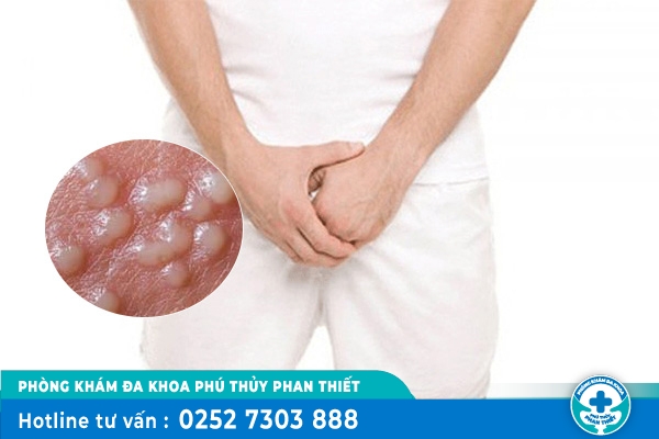 Nổi mụn ở bao quy đầu là bệnh gì?