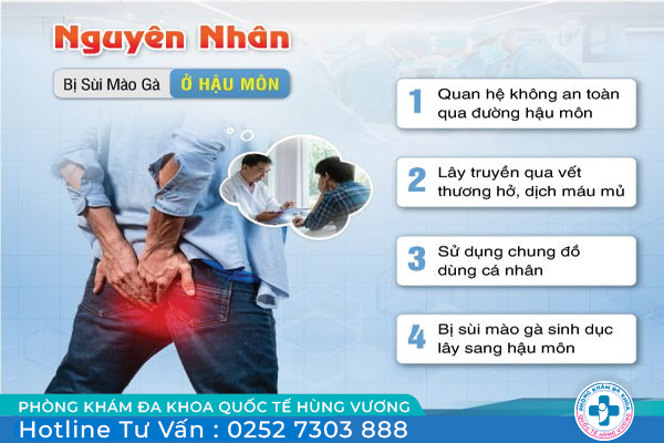 Nguyên nhân gây bệnh sùi mào gà ở hậu môn và cách chữa trị an toàn