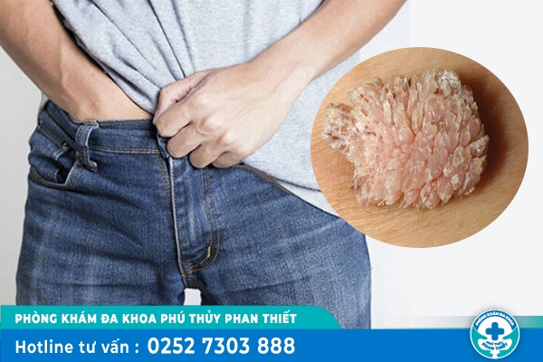 Sùi mào gà ở nam giới sẽ có biểu hiện gì?