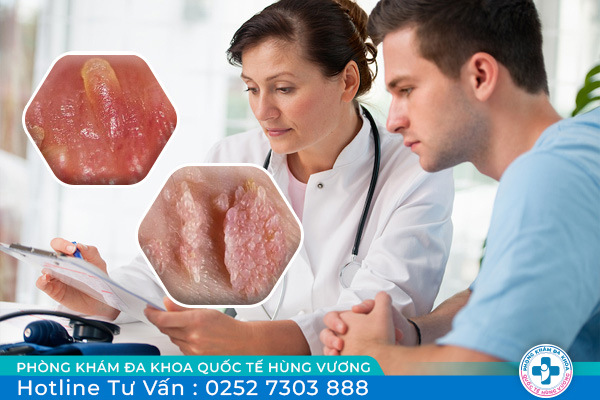 Phân biệt hạt ngọc dương và sùi mào gà như thế nào?