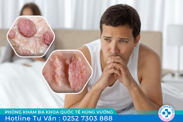 Một số dấu hiệu sùi mào gà ở nam giới cần lưu ý
