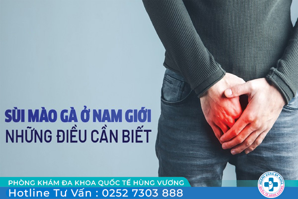 Sùi mào gà ở nam và cách điều trị hữu hiệu tại Phòng Khám ĐA KHOA HÙNG VƯƠNG